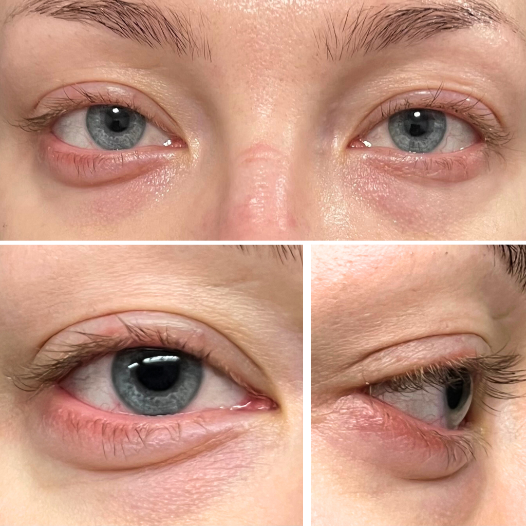 Allergic Reaction to Eyelash Glue | Symptoms, Prevention, & Treatment