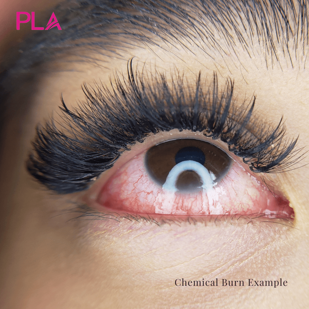Chemical Burn From Lash Extensions 